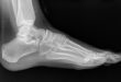 Un quart des os de votre corps sont situés dans vos pieds